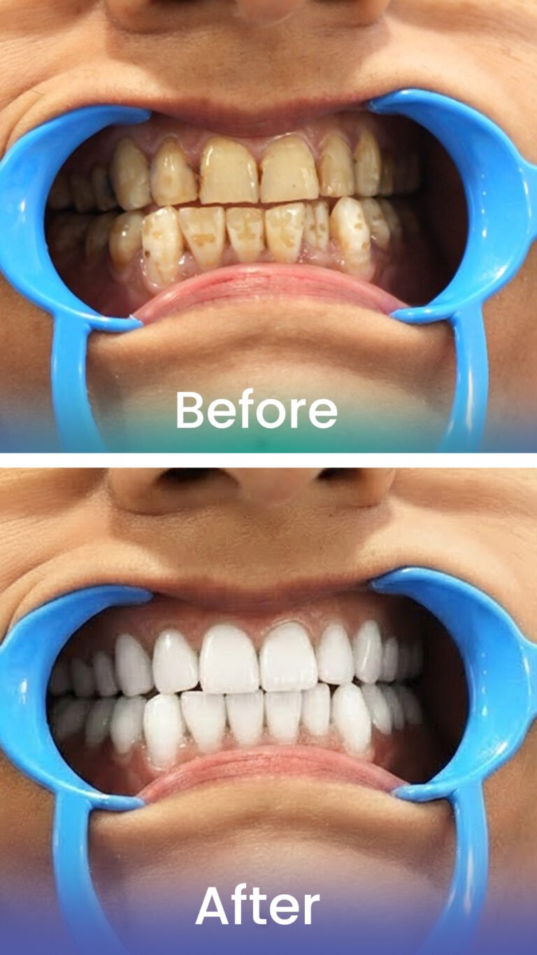 Before and after: teeth whitening and restoration