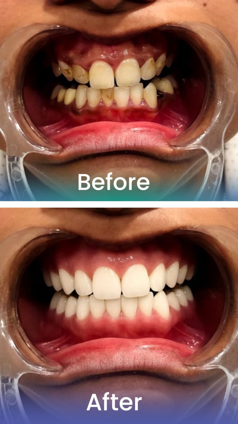 Before and after: smile makeover