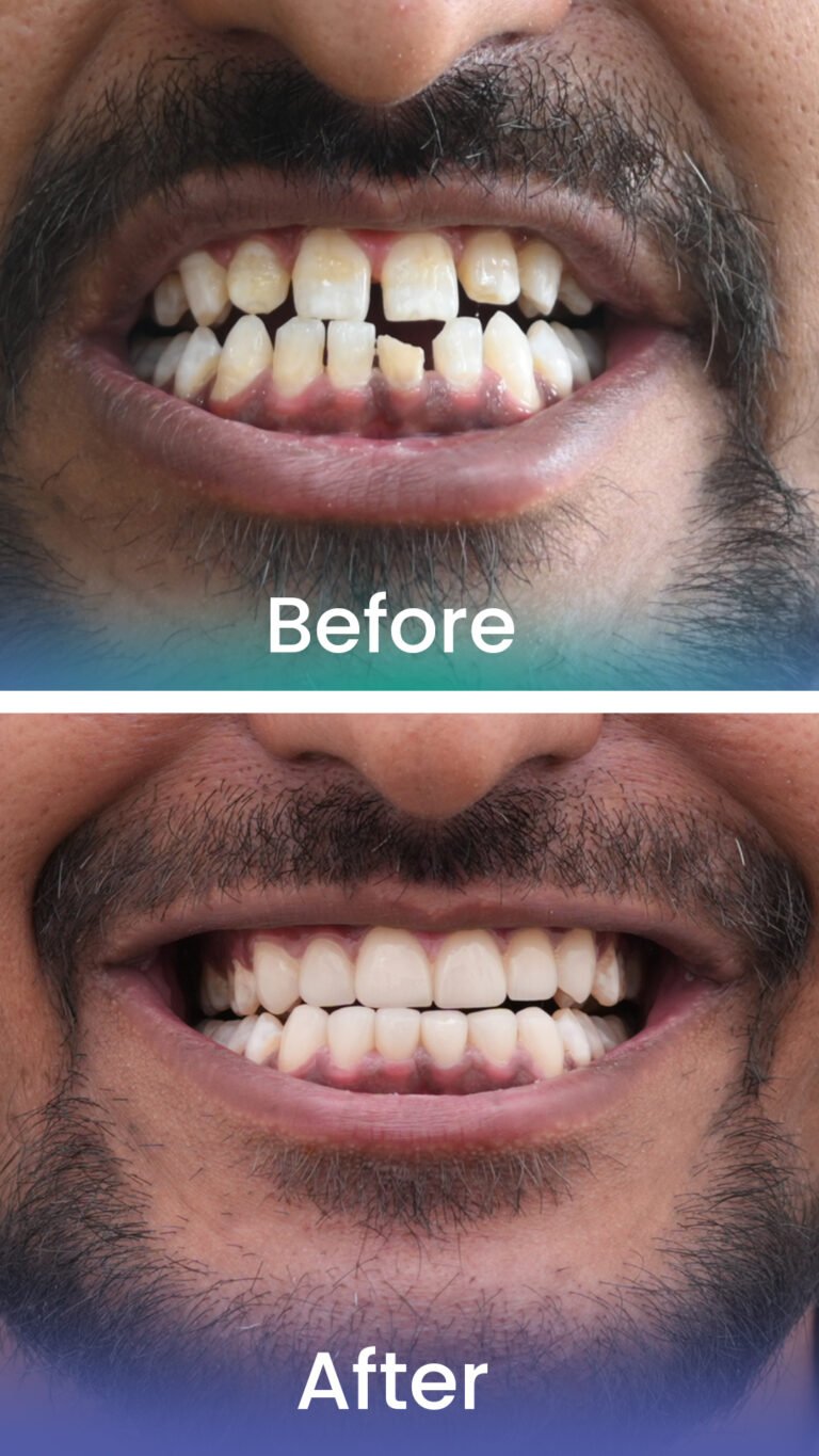 Before and after: cosmetic dental treatment