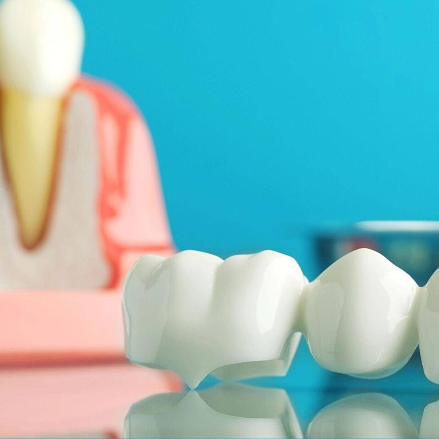Dental crowns and bridges