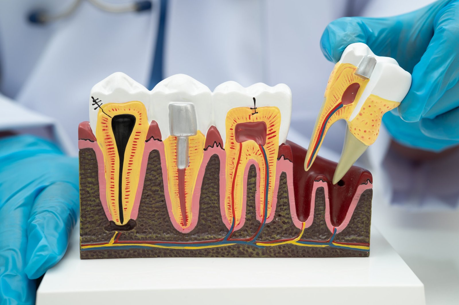 Dental implant treatment